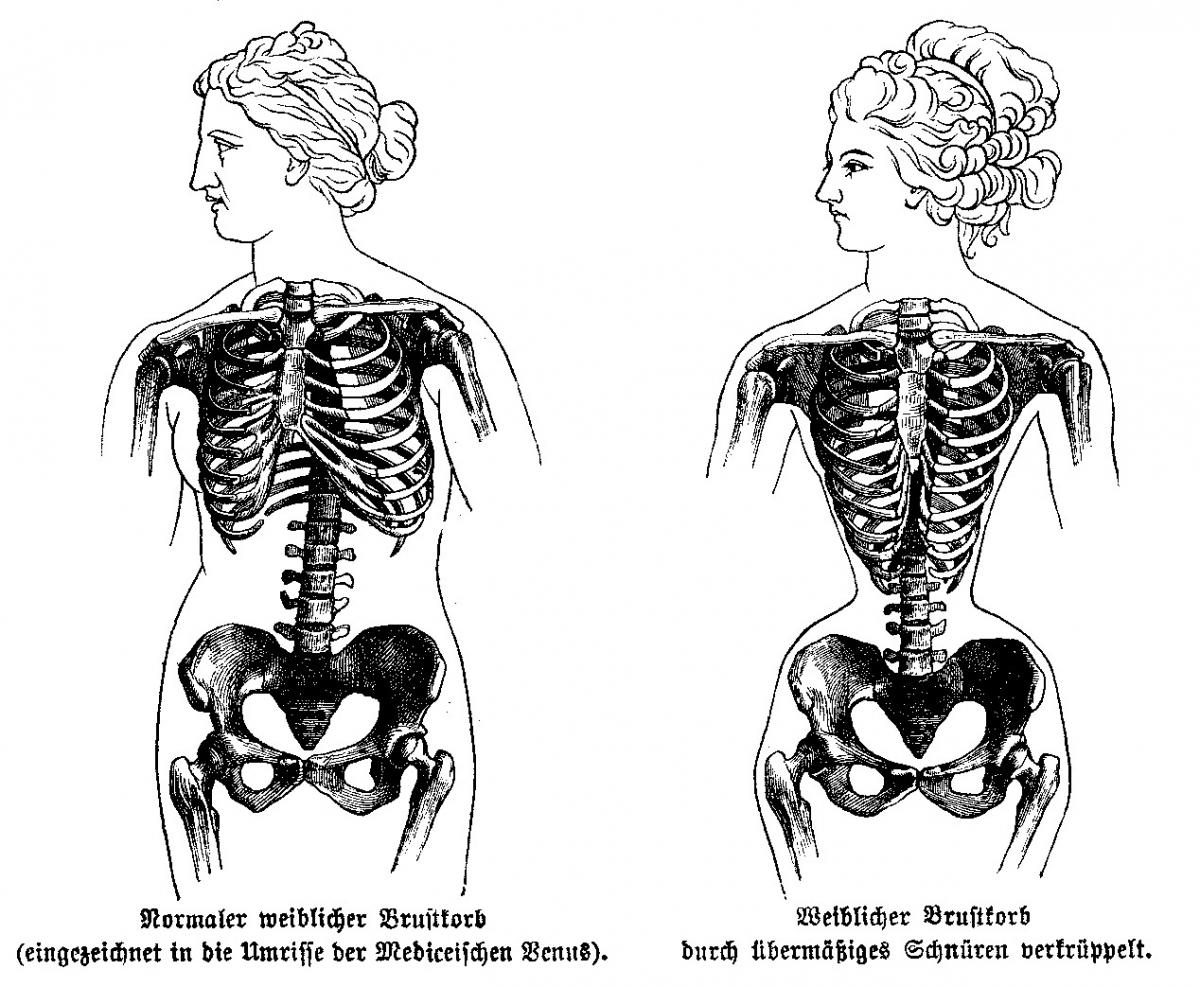 Das Korsett schadet dem Körper